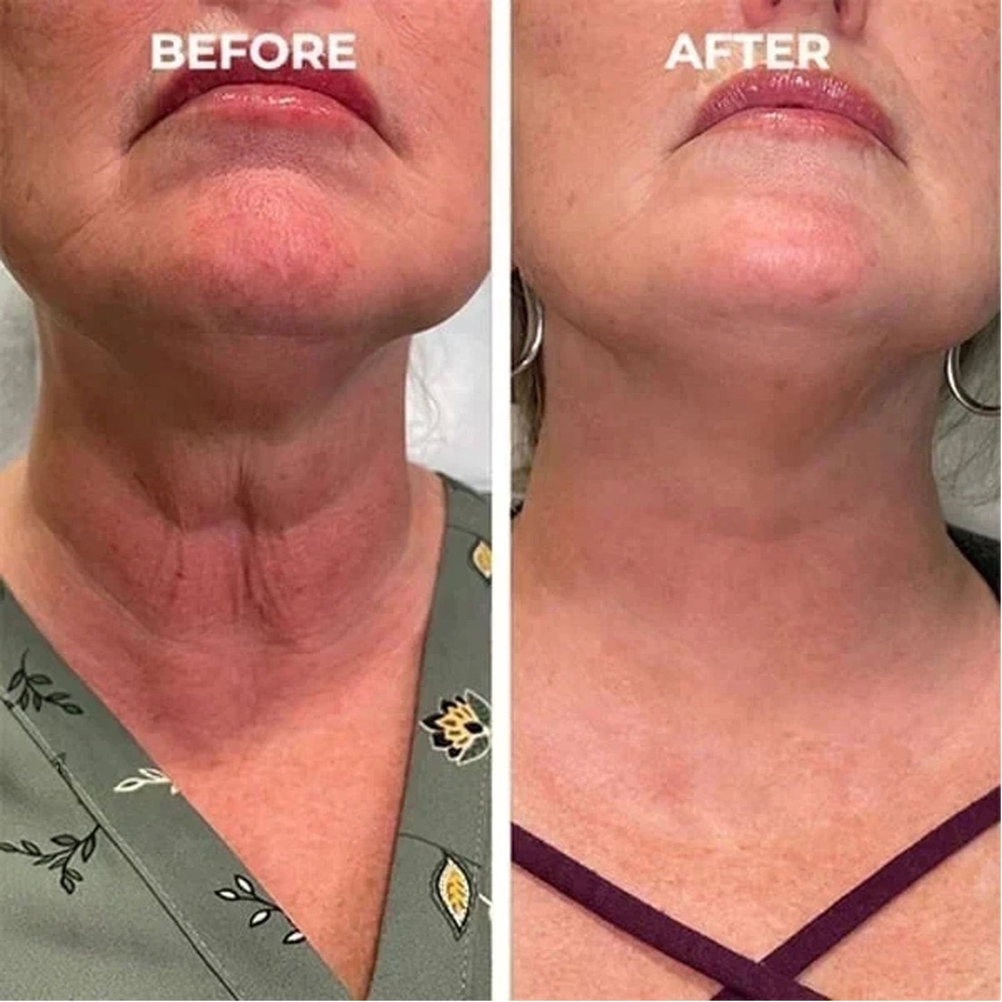 🔥👩⚕️Last Day Promotion 𝟕𝟎%𝐎𝐅𝐅 - Fuzero™ SkinFirming Rejuvenating Serum🔥