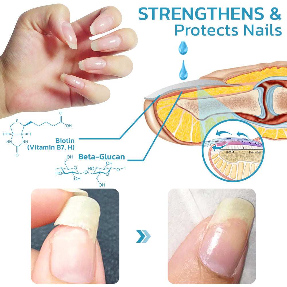 flysmus™ OnycholysisHeal Nail Strengthening And Growth Conditioner