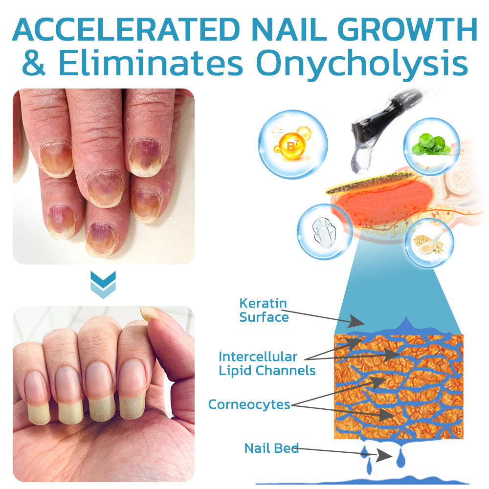 flysmus™ OnycholysisHeal Nail Strengthening And Growth Conditioner