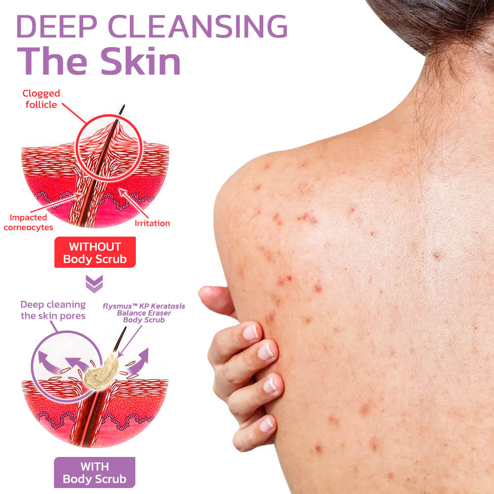 flysmus™ KP Keratosis Balance Eraser Body Scrub