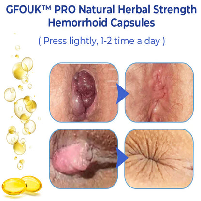 GFOUK™ PRO Natural Herbal Strength Hemorrhoid Capsules