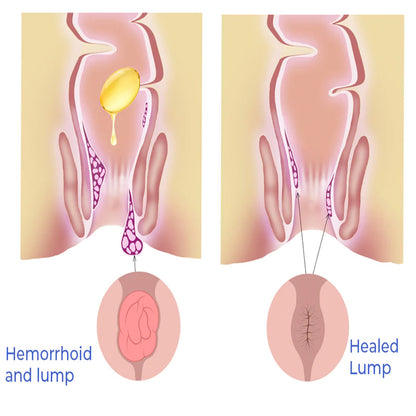 GFOUK™ PRO Natural Herbal Strength Hemorrhoid Capsules