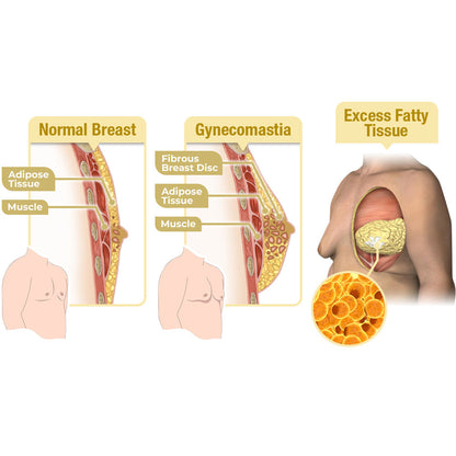 🌍GFOUK™ MenTherm Bee Venom Gynecomastia Heating Oil