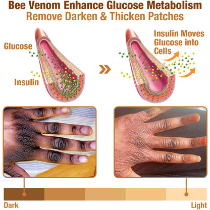 GFOUK™ ShineLuster Acanthosis Nigricans Bee Venom Soap