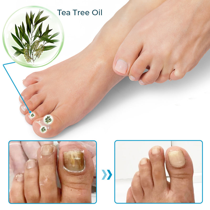 ✚Furzero™ Bee Venom Nail Fungus Treatment Solution💅