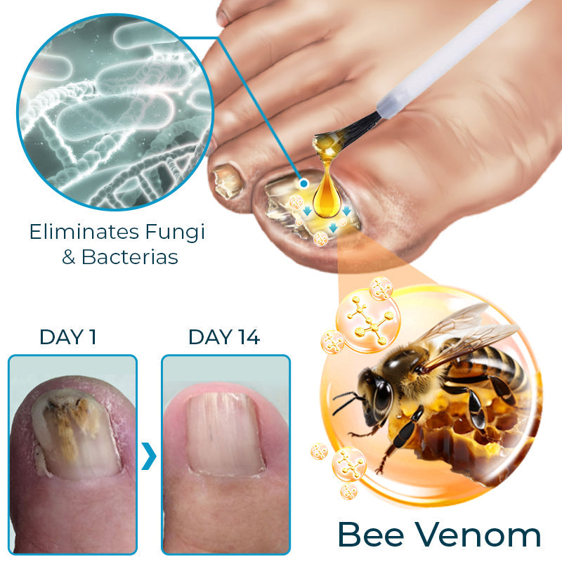 ✚Furzero™ Bee Venom Nail Fungus Treatment Solution💅