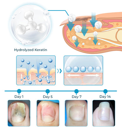 ✚Furzero™ Bee Venom Nail Fungus Treatment Solution💅