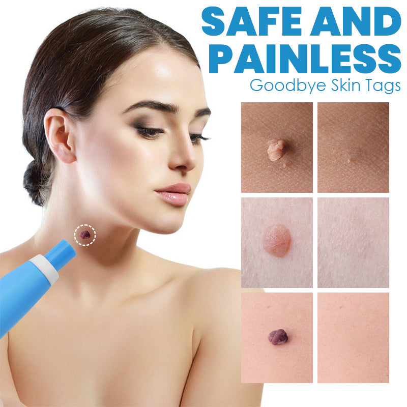 FibrOUT Auto Skin Tag Removal Kit