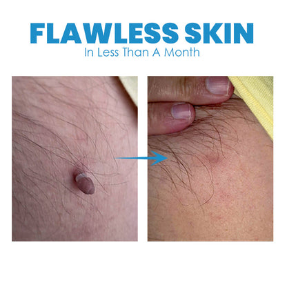FibrOUT Auto Skin Tag Removal Kit