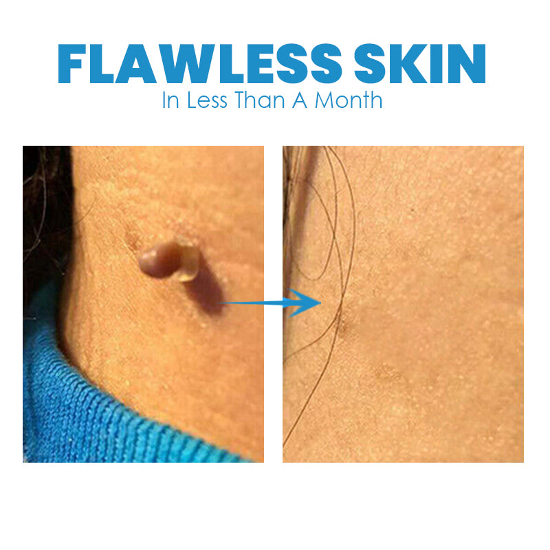 FibrOUT Auto Skin Tag Removal Kit
