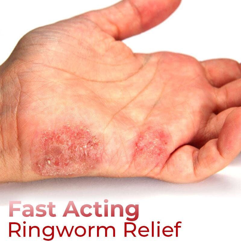 GFOUK™ Hand Ringworm Relief Spray