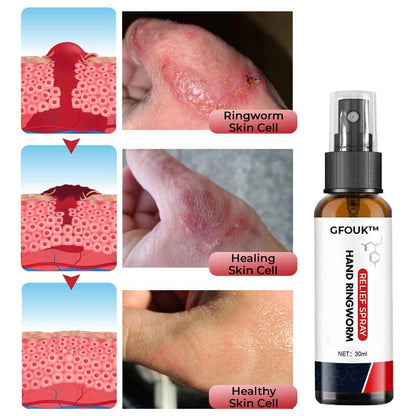 GFOUK™ Hand Ringworm Relief Spray